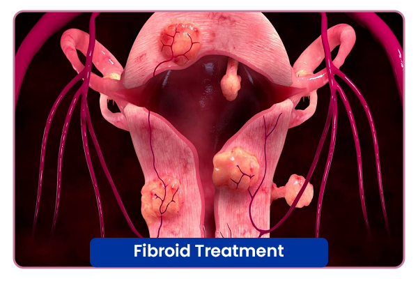 Fibroid Treatment