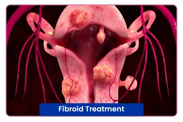 Fibroid Treatment