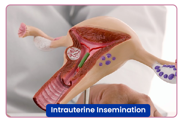 Intrauterine Insemination