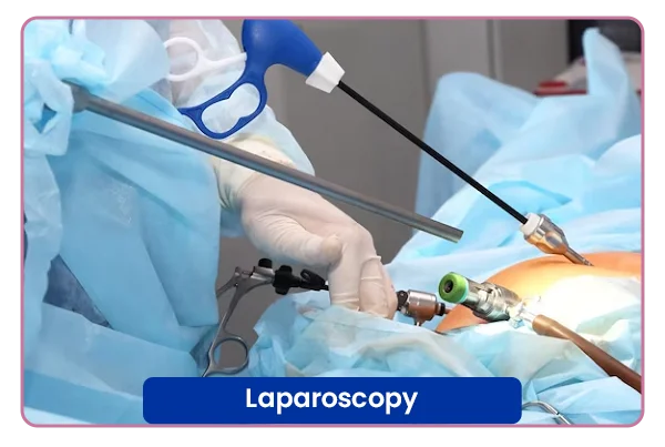 Laparoscopy Surgery